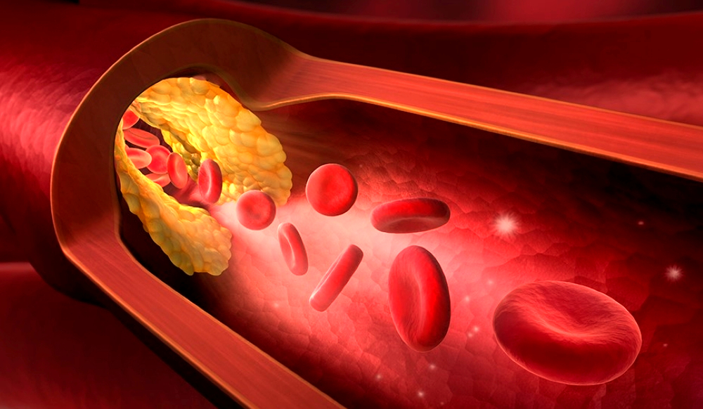 Ateroskleroza_ožilje